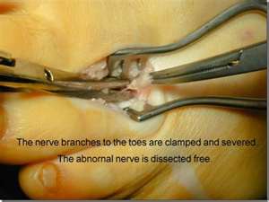 neuroma resection